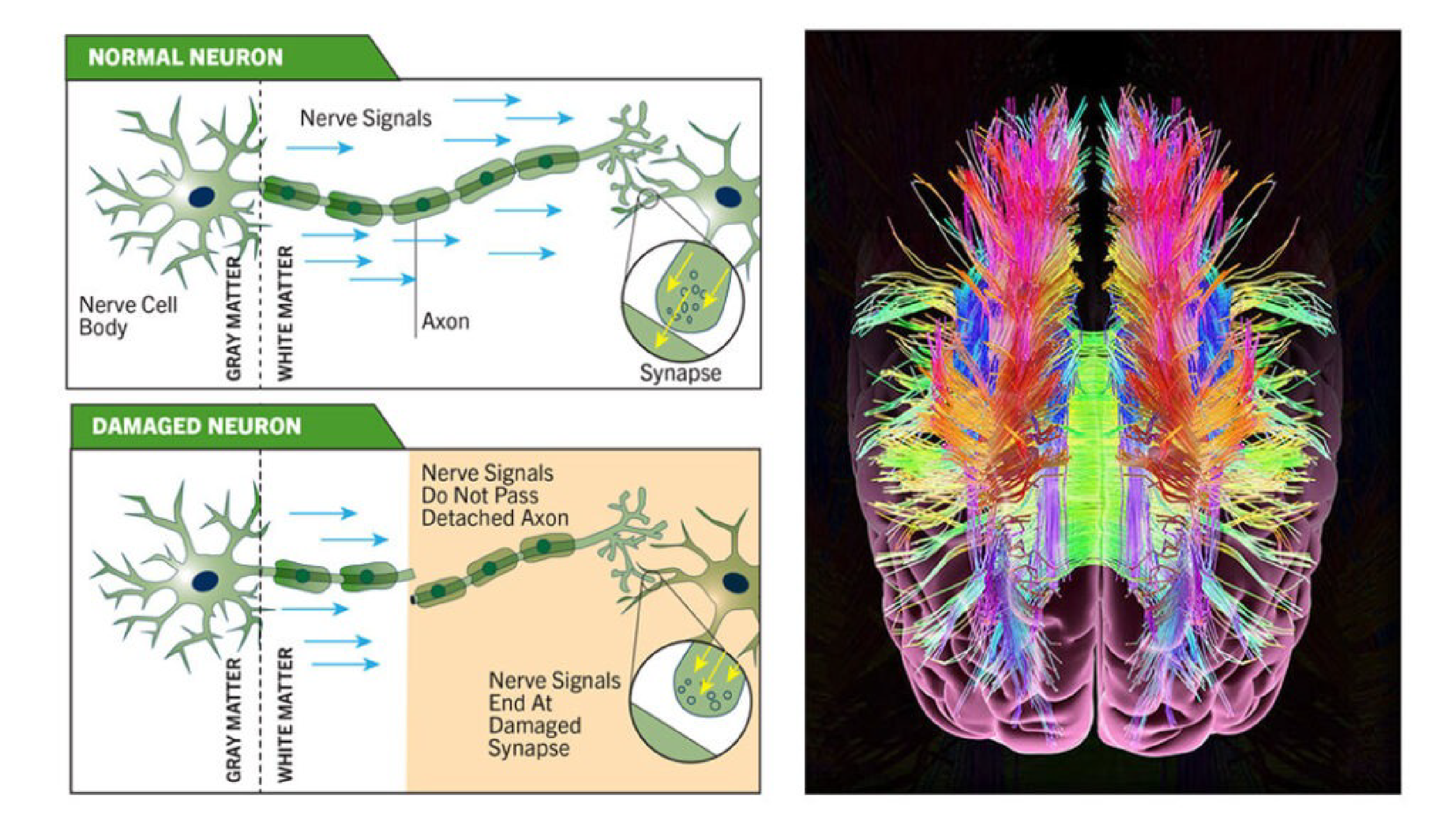 Normal vs Damaged Neuron Comparison